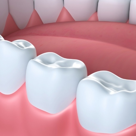 Animated teeth with dental sealants