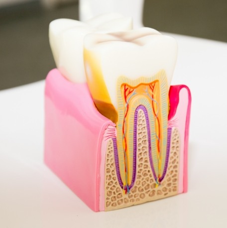 Model tooth used to explain pulp therapy