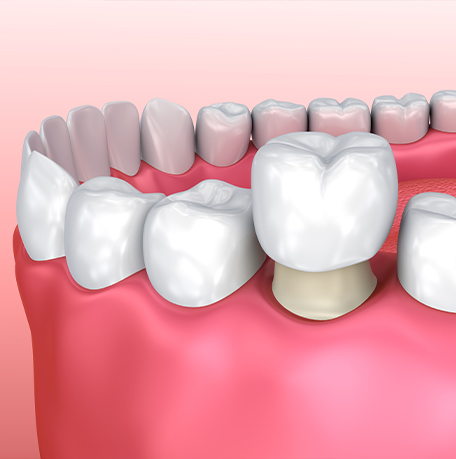 Illustration of a dental crown being fitted over a tooth