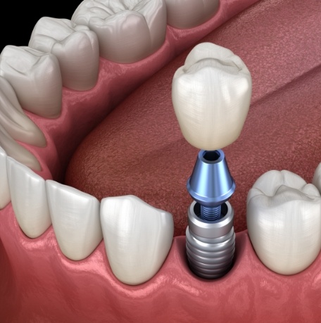 Animated smile showing the stages of dental implant treatment
