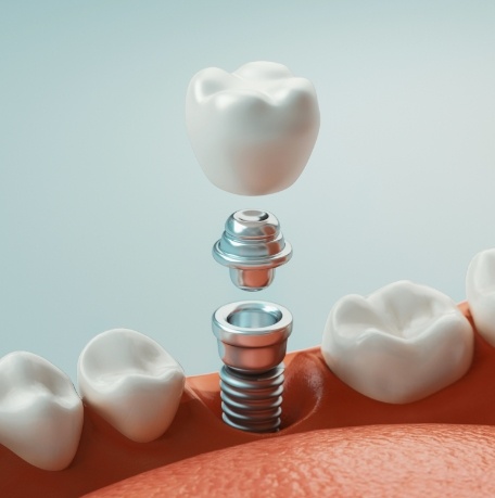 Animated smile representing the four step dental implant process