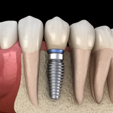 Animated smile during dental implant supported dental crown placement
