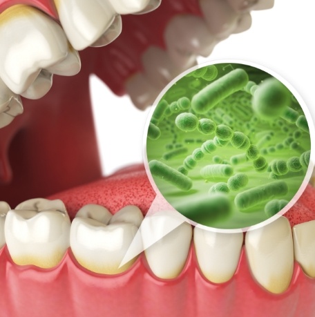 Animated smile showing how bacteria damages teeth without dental sealants