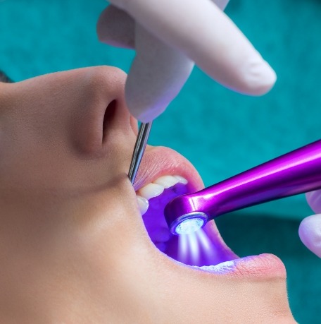 Closeup of dentist placing dental sealants