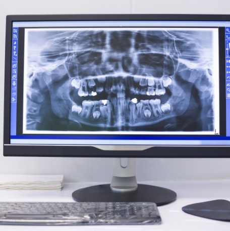 Digital x rays on a chairside computer screen