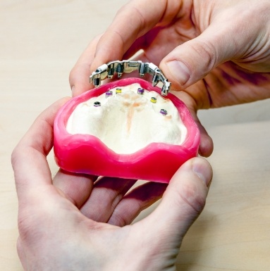 Dentist showing dental patient implant denture model