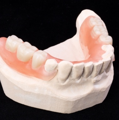 illustration for partial dentures in Soldotna 