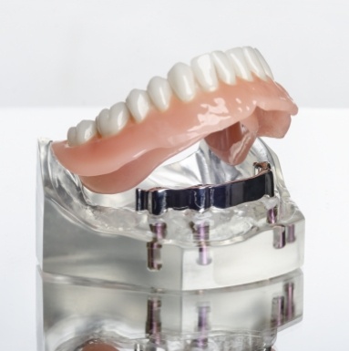 illustration for implant dentures in Soldotna 