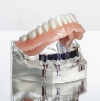 Model implant denture