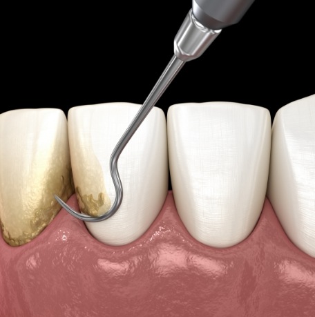 Animated smile during scaling and root planing