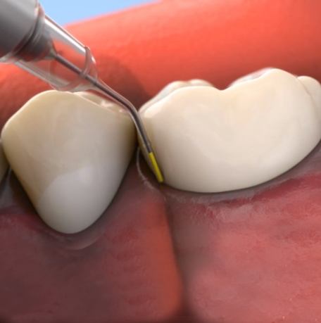 Closeup of smile receiving topical antibiotic treatment