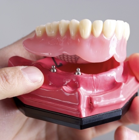 Model dental implant denture