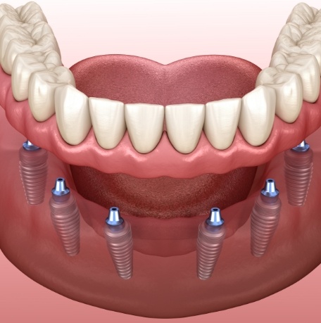 Animated implant denture placement