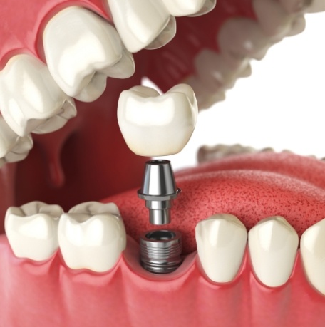 Animated smile during dental implant placement