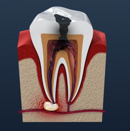 Animated tooth in need of root canal treatment