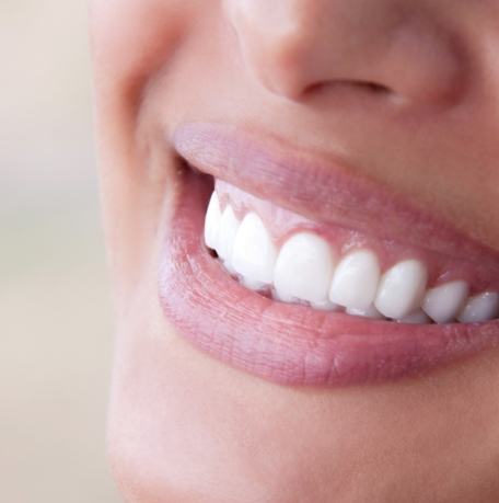 Closeup of flawless smile after makeover