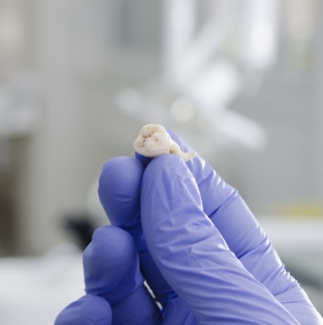 Dentist holding an extracted tooth
