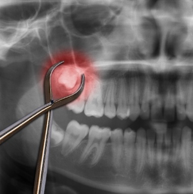 X ray of impacted wisdom tooth