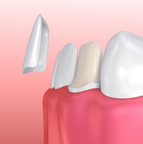 Animated smile during veneers placement