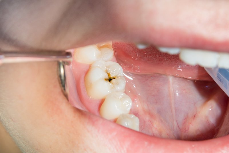 up-close view of a person with a cavity